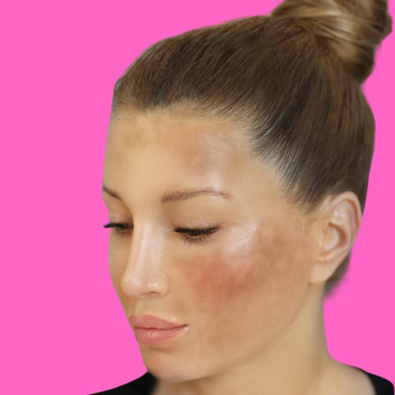 melasma